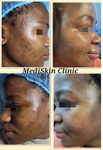 Acne & Acne Scar treatment