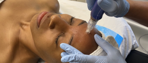 Microneedling and Mesotherapy